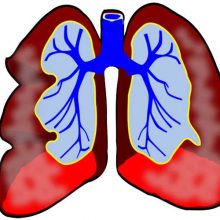 Thema Lungenerkrankungen